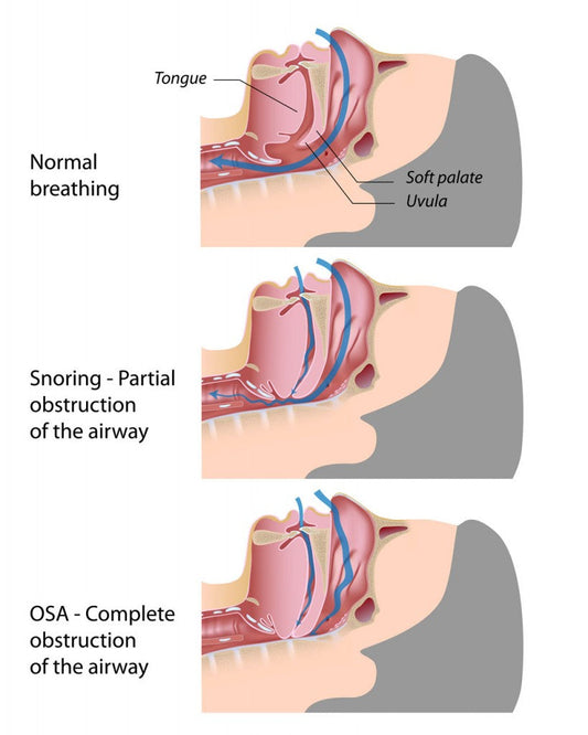 Sleep Apnea for Dummies